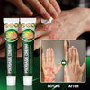 Psoriasis Cream - Herbal Plant Extracts